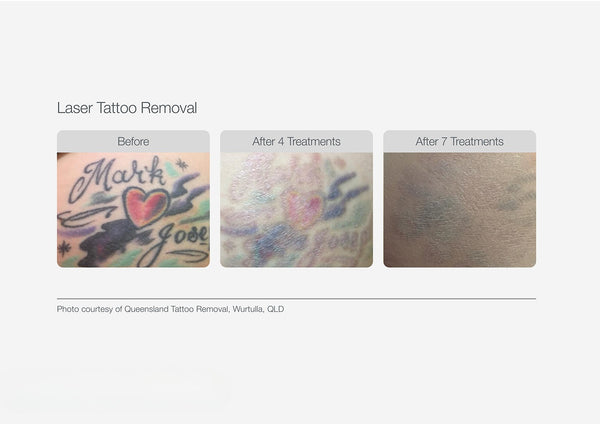 Tattoo Removal