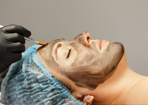 Carbon Laser Facial